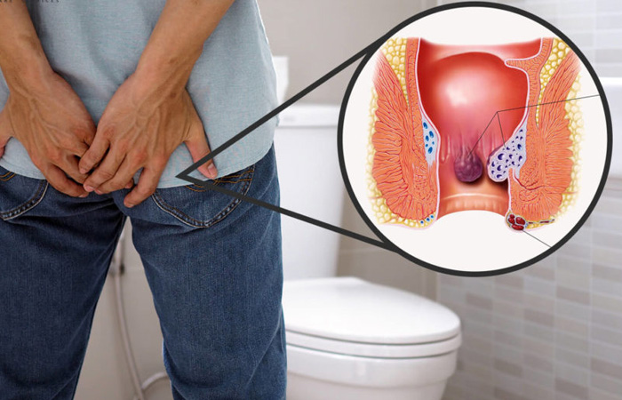 Piles Treatment
